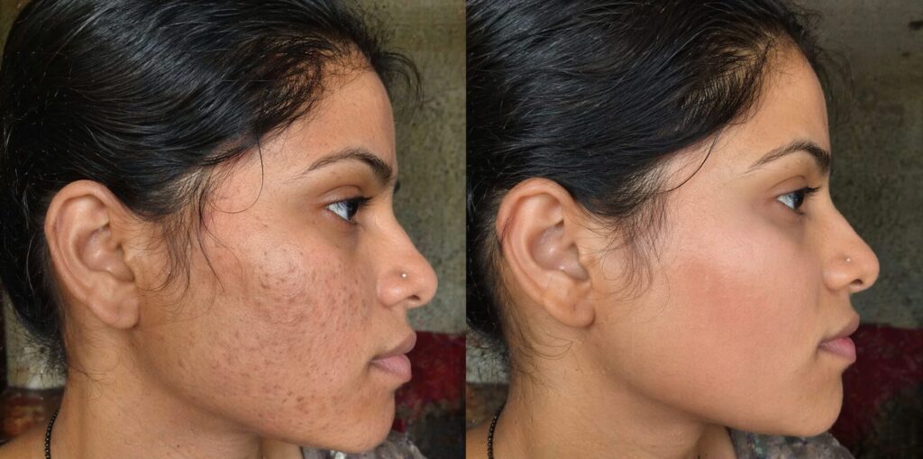 Acne & Acne Scar Treatment