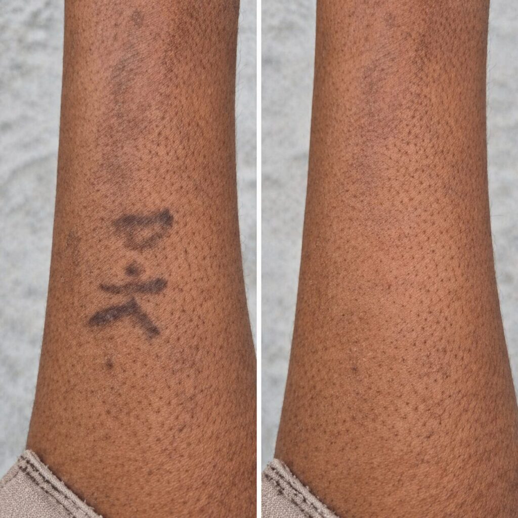 tatto remove