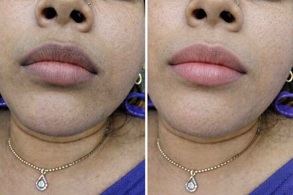 Laser Lip Pigmentation treatment